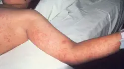 Half of US states have reported measles cases this year